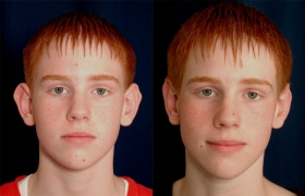 Otoplasty before after