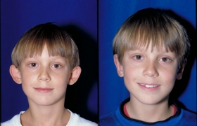 Otoplasty photos
