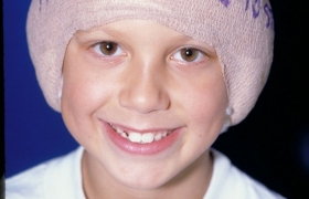 Otoplasty pictures