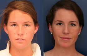 Before after ear surgery