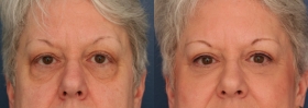 Before after eyelid surgery