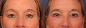 Upper blepharoplasty with Ptosis repair and lower lid laser resurfacing