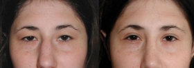 Before after eyelid lift Baltimore