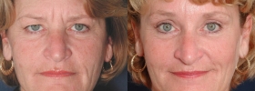Eyelid surgery photos