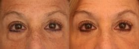 Before after eyelid surgery