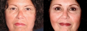 Blepharoplasty photos