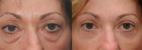 Before after eyelid surgery
