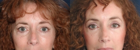 Before after blepharoplasty