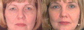 Best eyelid surgery results