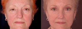 Eyelid lift photos