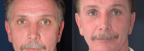 Eyelid lift pictures