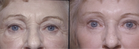 Eyelid lift results
