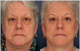 Before and After Face Lift in Baltimore