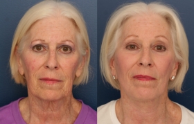 SMAS Facelift