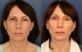 SMAS facelift, Endobrowlift and Fat Grafting