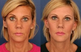 SMAS facelift, fat grafting, Mini temporal Lift