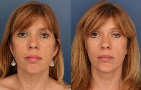 Composite Face and Midface Lift, Lower eyelid blepharoplasty, Limited Incision Browlift, Chin Implant