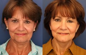 Composite facelift, lower lid blepharoplasty, limited incision endo browlift