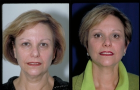 Composite Facelift, Upper and Lower eyelid Blepharoplasty and Browlift
