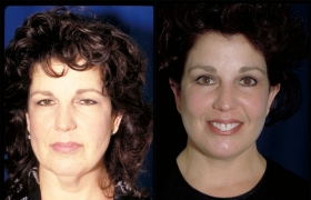 Composite Facelift, Upper and Lower Eyelid Blepharoplasty and Browlift