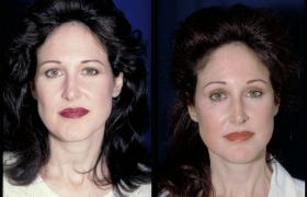 SMAS Facelift, Endobrowlift and Upper and Lower Blepharoplsty
