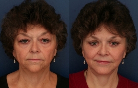Composite Facelift, Midface Lift, Upper and Lower Eyelid Blepharoplasty, Limited Incision Browlift, Chin Implant Genioplasty