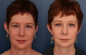 Composite Facelift, Midface Lift, Endobrow Lift, Lower Eyelid Blepharoplasty, Excision of Buccal Fat Pads (No upper eyelid surgery)