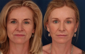 Composite Facelift, Midface lift, Upper and Lower Blepharoplasty, Limited Incision Endobrowlift, Perioral Lasr Resurfacing