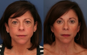 SMAS Facelift, Upper and Lower eyelids, Limited Incision Browlift and Cheek Implant Augmentation Surgical Technique: Facelift, Cheek Implants