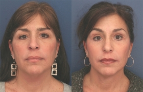 Composite Face and idface Lift, Lower Eyelid Blepharoplasty and Limited Incision Browlift