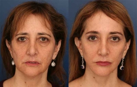 SMAS Facelift, Lower Eyelid Blepharoplasty, Limited Incision Endoscopic Browlift, Fascia graft Lip Enhancement