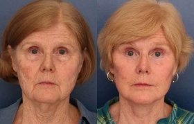 Composite Facelift, Midface Lift, Lower Eyelid Blepharoplasty, Limited Incision Endoscopic Browlift