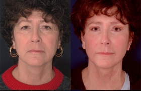 Composite Facelift, Midface lift, Upper and Lower Blepharoplasty and Limited Incision Endoscopic Browlift
