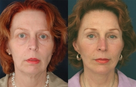 Composite Facelift, Mifdface Lift, Upper & Lower Blepharoplasty, Limited Incision Endoscopic Browlift, Chin Implant