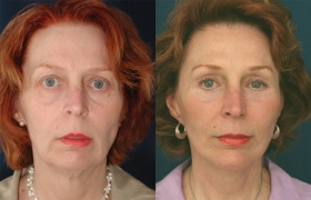 Composite Facelift, Mifdface Lift, Upper & Lower Blepharoplasty, Limited Incision Endoscopic Browlift, Chin Implant