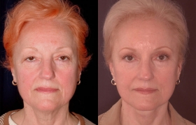 Composite Facelift, Midface lift, Limited Incision Endobrow lift, Upper and Lower Blepharoplasty
