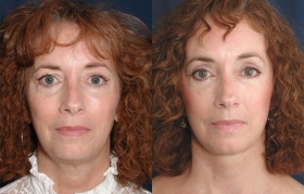 Composite Facelift, Midface lift, Limited Incision Endobrow Lift, Upper and Lower Blepharoplasty