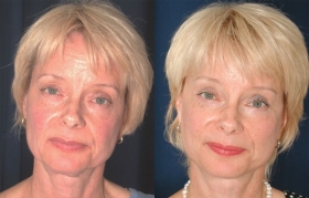 Composite Facelift, Midface Lift, Upper and Lower Blepharoplasty, Open Hairline Browlift