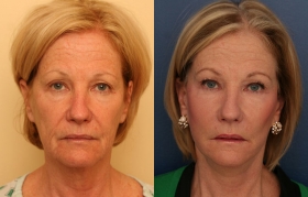 SMAS Facelift, Fat Grafting and Mini Temporal Lift