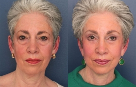 Composite Face/Midface Lift, Limited Incision Endo Browlift, Upper & Lower Blepharoplasty