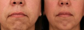Treatment of upper lip and corners of mouth