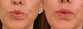 Treatment of lip forrows with Volbella