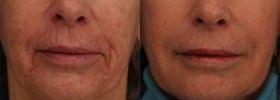 Treatment of Lip Lines and Perioral area with Juvederm
