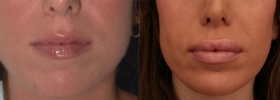 Perlane Lip Enhancement