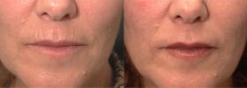 Wrinkle Reduction with Restylane