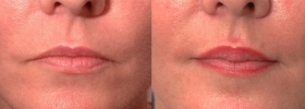 Restylane Lip Injections