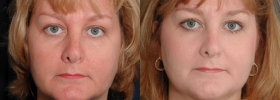 Before after facial fat transfer