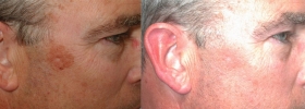 Sun spot removal with IPL