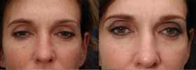 Before after IPL Treatment