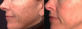 Photofacial Therapy Baltimore